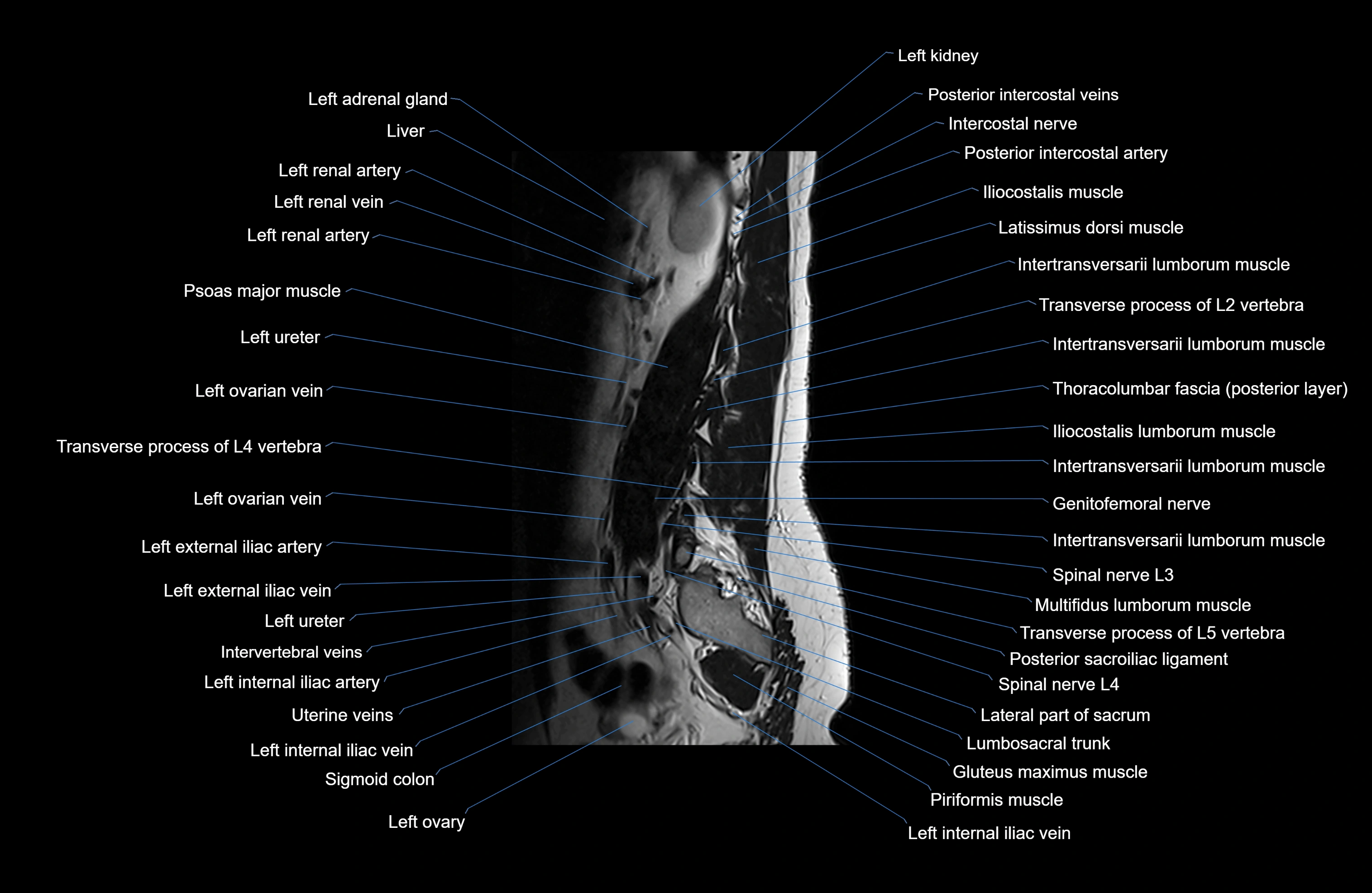 MRI lumbar spine sagittal cross sectional anatomy 3T radiology  image-img-00001-00025.webp
